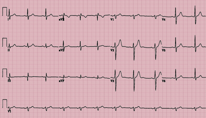 Image result for ekg